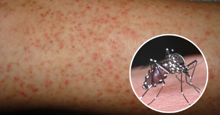 sốt xuất huyết