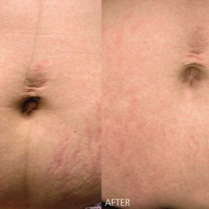 Tinh dầu chống rạn da