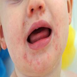 Bệnh tay chân miệng là bệnh do virus đường tiêu hóa gây ra